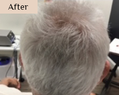 injections for hair loss treatment - before and after results